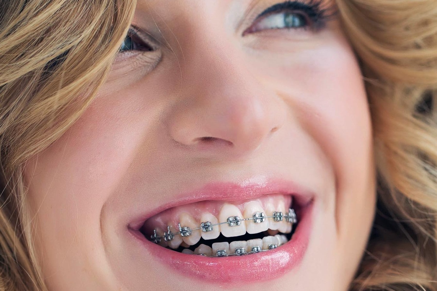 Metal braces closeup