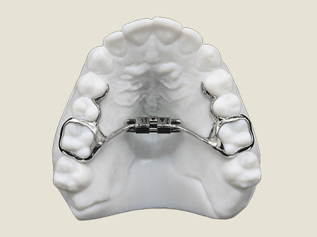 Close-up of a fixed rapid palatal expander appliance