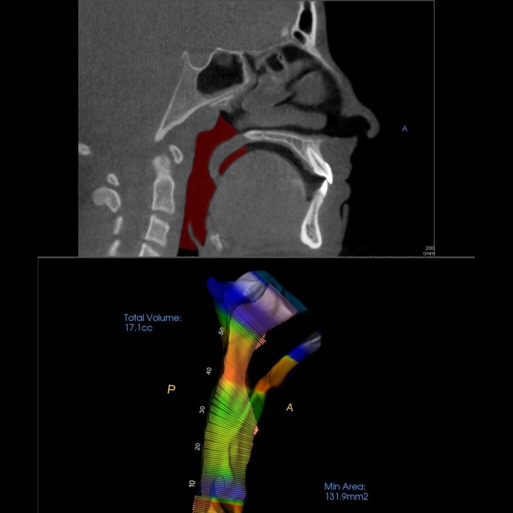 CBCT airway evaluation: a side-view scan slice with the airway highlighted in red, above a colour-mapped 3D model of the same airway showing its total volume and narrowest cross-section