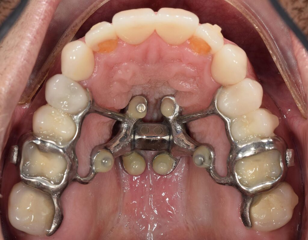 A MARPE expander seated in the roof of the mouth, anchored by six composite-covered screws, with metal bands on the back teeth