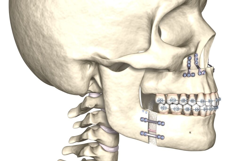 Illustration of a skull in profile showing surgical plates on the upper and lower jaw, with braces on the teeth